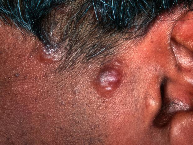Image of B-cell cutaneous lymphomas on the side of somebody's face, beside their ear