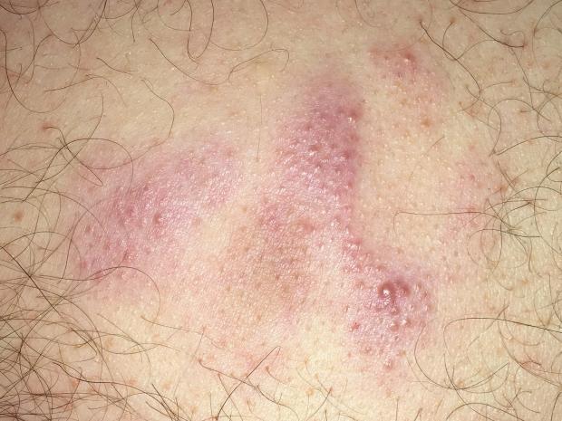 Image of primary cutaneous marginal zone lymphoma