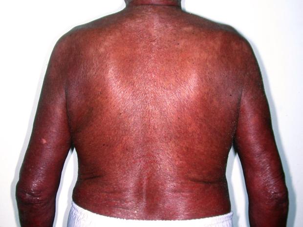 Image of erythroderma and patches of hypopigmented (lighter) skin 