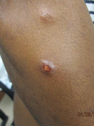 Image of primary cutaneous anaplastic large-cell lymphoma (ALCL) tumours 