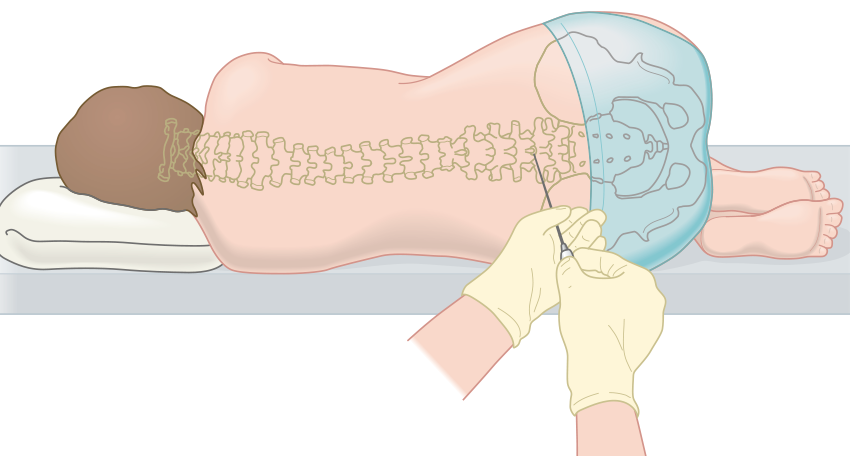 chemo.spine