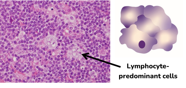 An image of a Lymphocyte-predominant cell under a microscope