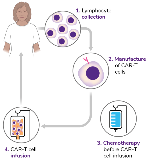 A diagram of the CAR-T cell treatment process: lymphocyte collection, manufacture of CAR-T cells, chemotherapy before CAR-T cell infusion and finally CAR-T cell infusion