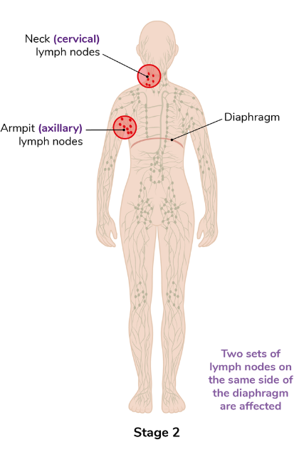 A diagram of stage 2 lymphoma where it is illustrated to be in two sets of lymph nodes in the same side of the diaphragm. The neck (cervical) lymph nodes, armpit (axillary) lymph nodes, and diaphragm are highlighted